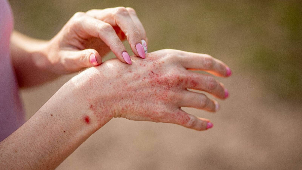 Dermatitis Atopik Dewasa